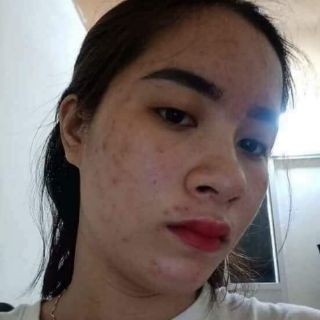 Hana Acnes