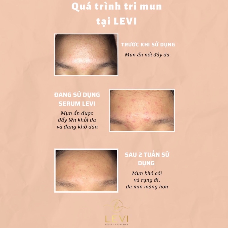 Serum mụn LEVI mờ thâm, trắng da, sạch mụn 100% sau 7 ngày | BigBuy360 - bigbuy360.vn