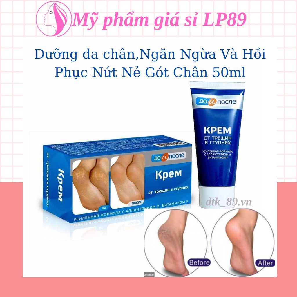 Kem nứt gót chân Nga Kpem,dưỡng da chân,Ngăn Ngừa Và Hồi Phục Nứt Nẻ Gót Chân 50ml