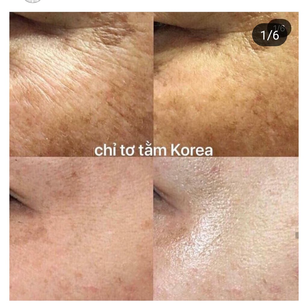 SET CHỈ CẤY TƠ TẰM CHITOSSIL AMPOULE