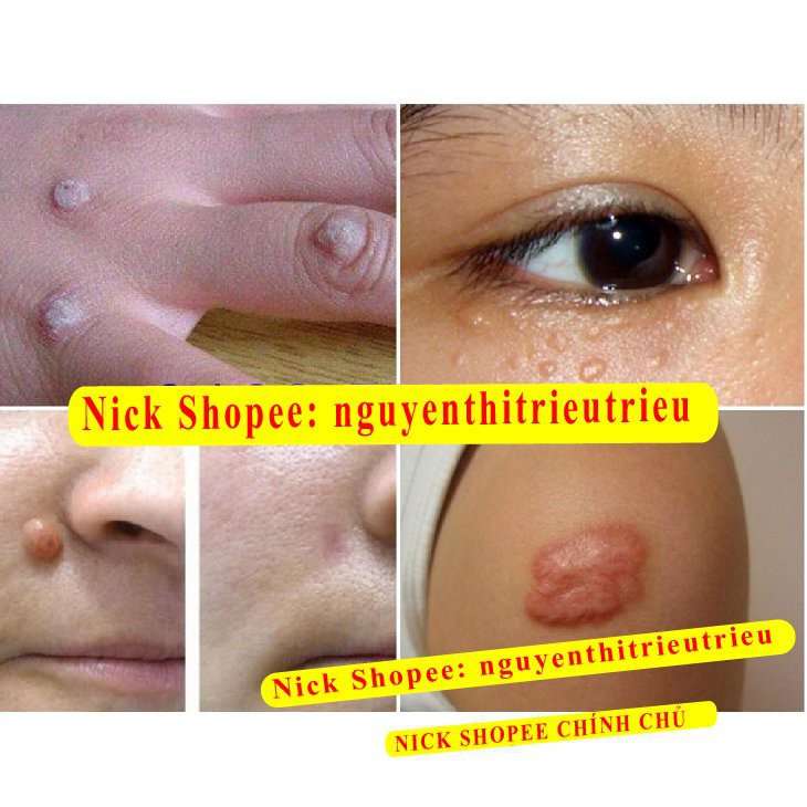 [Chính Hãng]GEL TẨY NỐT RUỒI, MỤN CƠM, MỤN CÓC, SẸO LỒI, THỊT THỪA - Dvelinil nhập khẩu Nga Hiệu quả Tốt | BigBuy360 - bigbuy360.vn