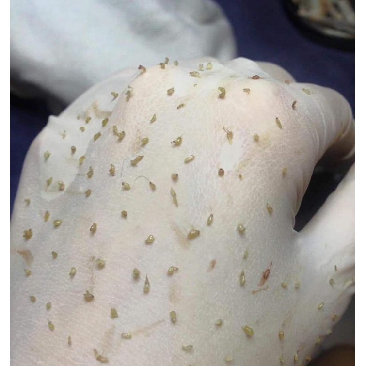 BỘ NẶN MỤN 4 CÂY