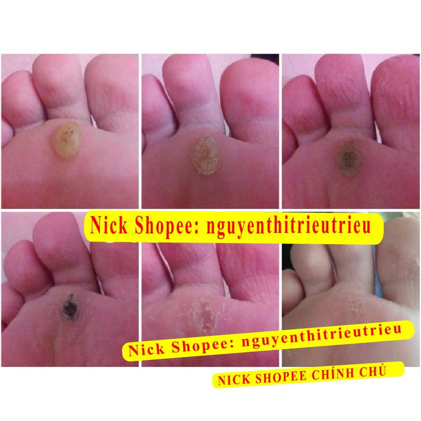 [Chính Hãng]GEL TẨY NỐT RUỒI, MỤN CƠM, MỤN CÓC, SẸO LỒI, THỊT THỪA - Dvelinil nhập khẩu Nga Hiệu quả Tốt | BigBuy360 - bigbuy360.vn