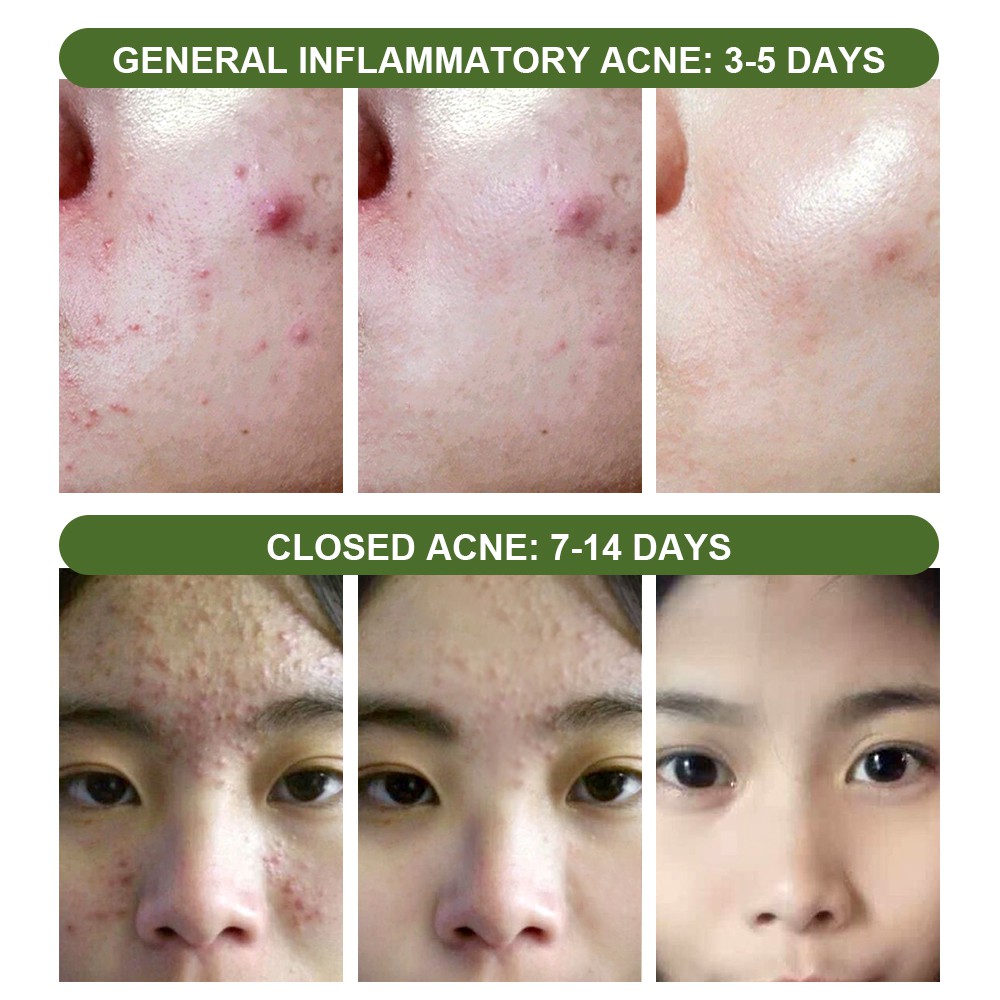 Gel Hỗ Trợ Giảm Mụn VIBRANT GLAMOUR Phục Hồi Làm Trắng Loại Bỏ Sẹo Mụn Đầu Đen Chăm Sóc Da 25g | BigBuy360 - bigbuy360.vn