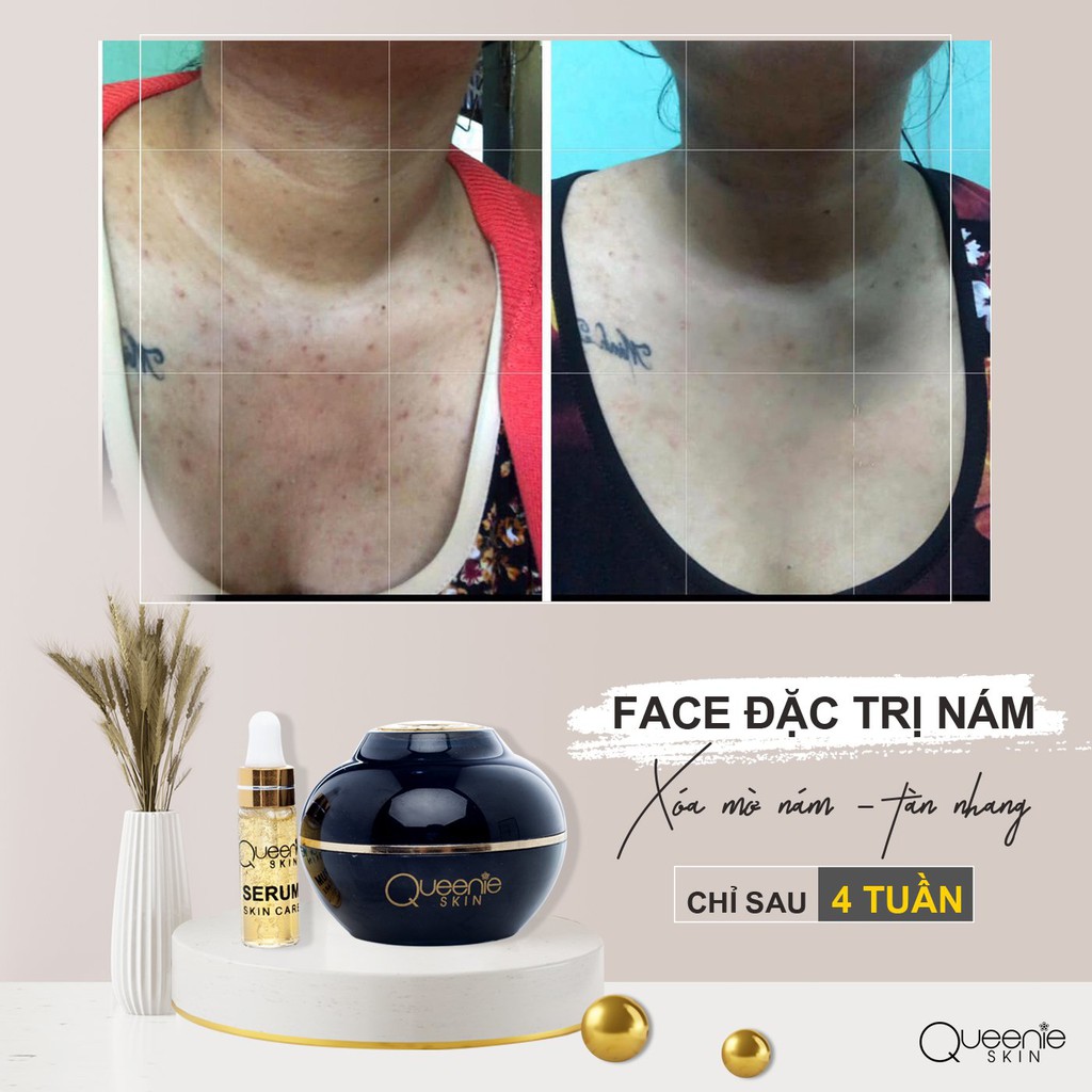 COMBO 2 Hộp Kem Nám, Tàn Nhang QUEENIE SKIN 30 Gram - HÀNG CHÍNH HÃNG