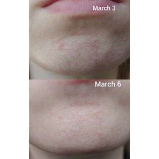 The Ordinary AHA 30% + BHA 2% Peeling Solution 30ml