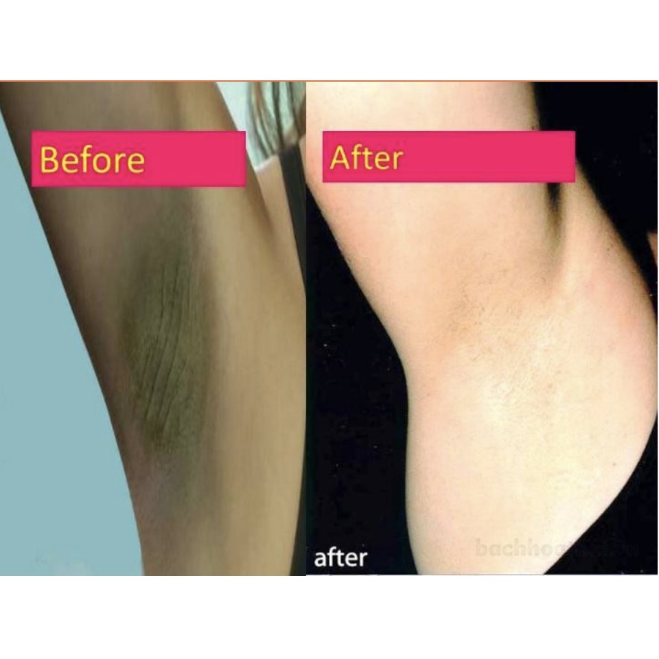 Kem khử thâm nách, bikini khuỷ tay chân 88 Total White Underarm Cream Thái Lan (35g) | BigBuy360 - bigbuy360.vn