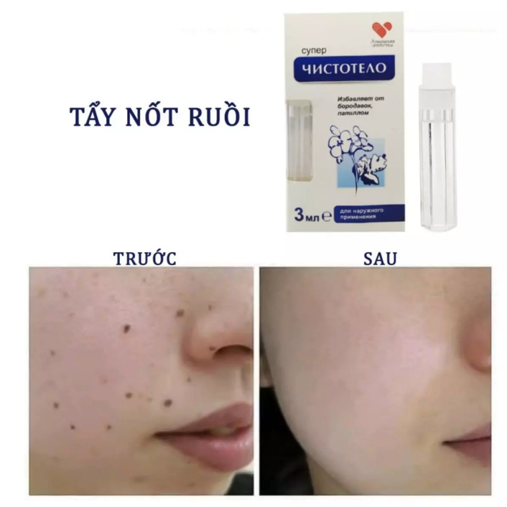 TẨY NỐT RUỒI DVELINIL tẩy nốt ruồi, mụn cơm, mụn cóc, sẹo lồi gel 3ml - Nga