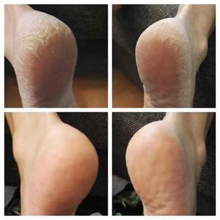 Kem dưỡng da chân, Kem nứt gót chân,dưỡng ẩm,ngăn ngừa và phục hồi giúp cho gót chân hồng hào, mềm mại Kpem 50ml