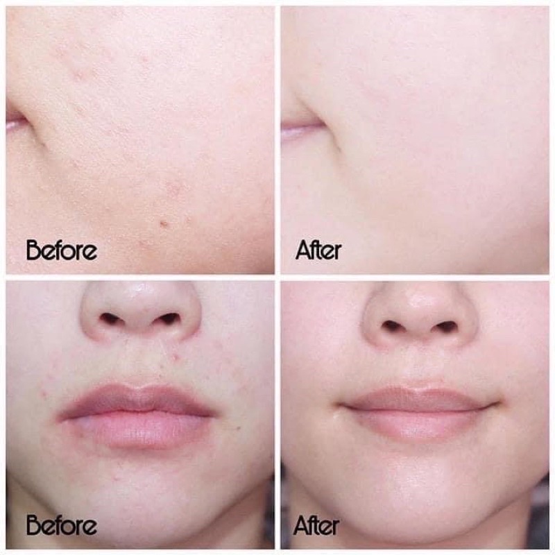 Tinh chất serum ngừa thâm mụn SVR sebiaclear serum