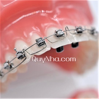 Lò xo Torquing ART Auxiliary ( sử dụng trong nha khoa )