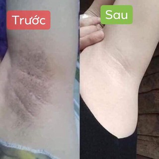 SIÊU DƯỠNG THÂM NÁCH-BỤNG-BIKINI
