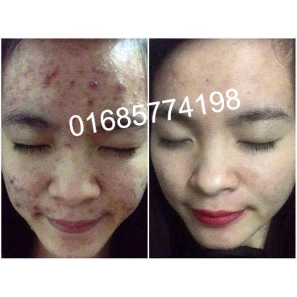 Kem Đông Y KEM MỤN Ngân Bình > Hết mụn thâm sẹo, mụn bọc mủ, mụn ẩn, mụn đầu đen > KEM XÓA MỤN ĐÔNG Y NGÂN BÌNH