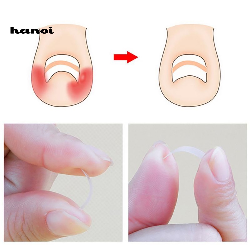 Bộ 10 Miếng Dán Chỉnh Hình Móng Chân Mọc Ngược