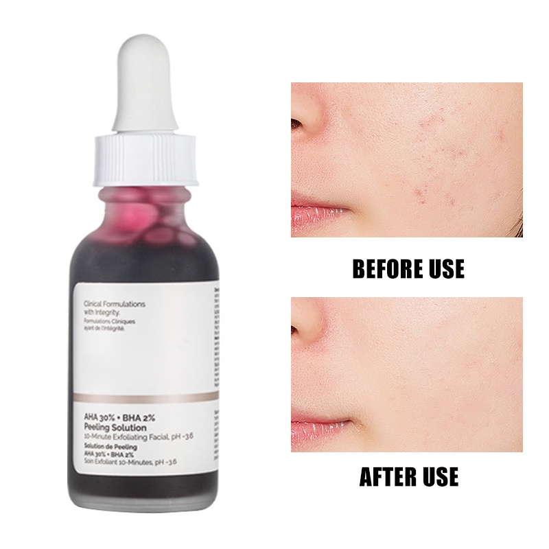 [Hàng mới về] Tinh chất loại bỏ mụn đầu đen The Ordinary AHA 30% BHA 2% dạng lột làm sáng da 30ml