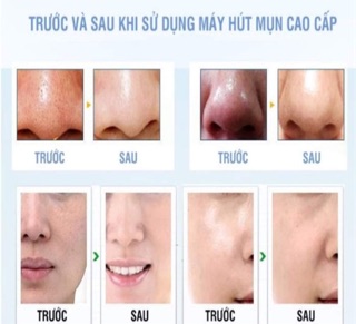 Máy hút mụn cầm tay