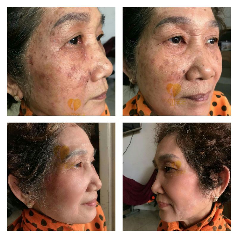 ⚡Serum tái tạo da Yody White Phương Anh làm sạch mụn nám tàn nhang 80ml