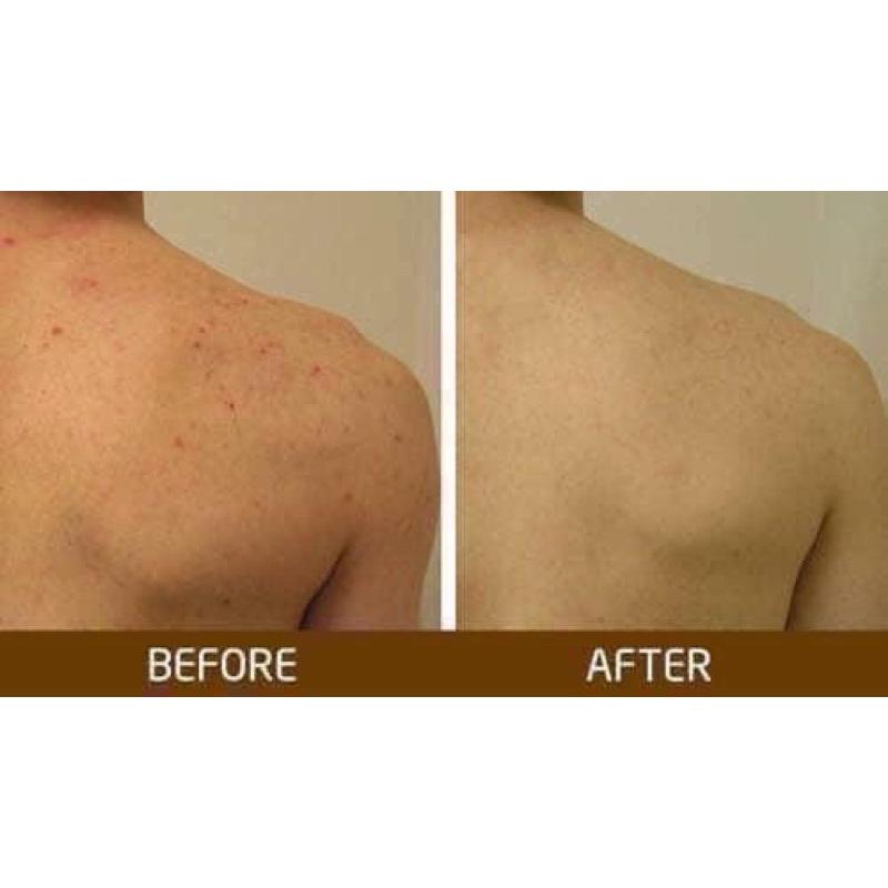 Xịt mụn lưng thái lan, Thâm Mụn Lưng Vitara SE Body Acne Spray