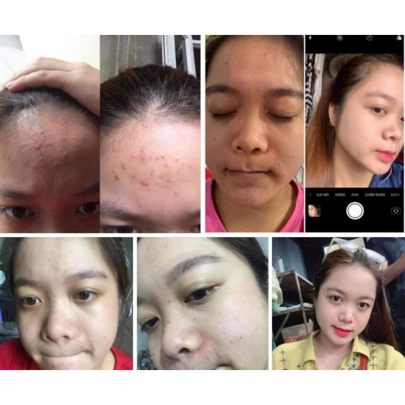 Kem Mụn X2 Th beauty