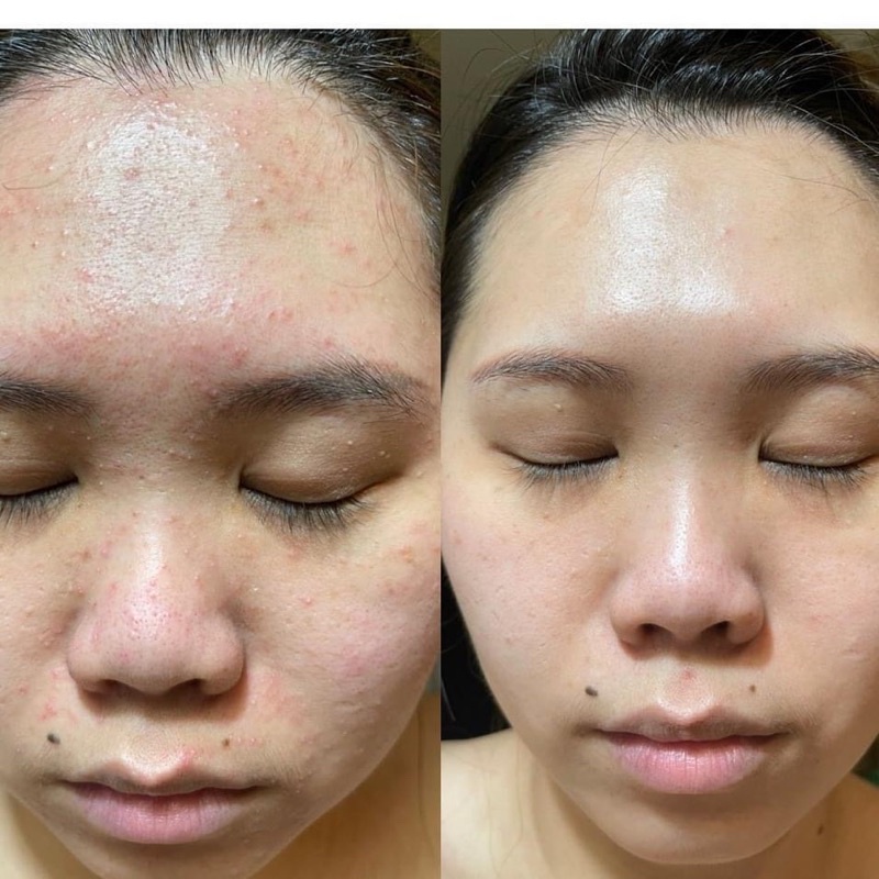 Mặt nạ Lacto Mask Onmacabim Lactic acid & tế bào gốc 30 ml