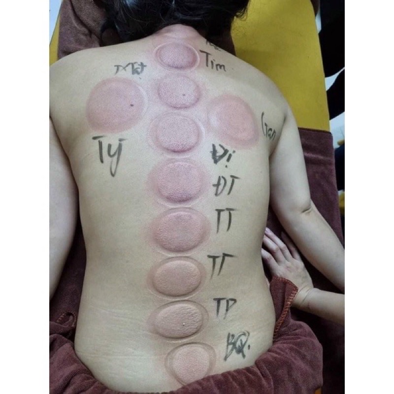 Bộ giác hơi ngải cứu cao cấp 2 trong 1- vừa giác hơi- vừa cứu ngải