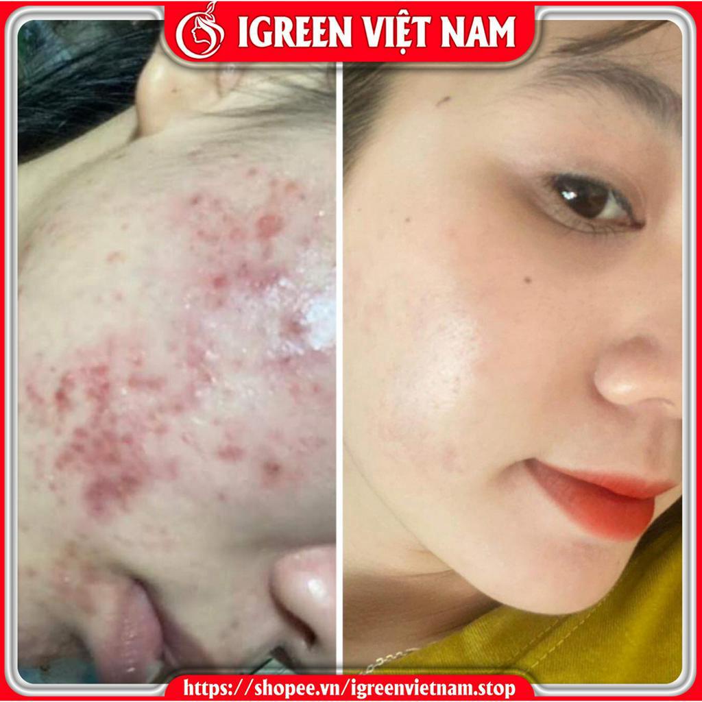 Serum Diếp Cá GIẢM MỤN, THÂM, SE KHÍT LỖ CHÂN LÔNG IGREEN - Serum Diếp Cá IGREEN