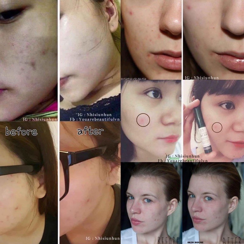 Tinh dầu Tea Tree Oil The Body Shop | BigBuy360 - bigbuy360.vn