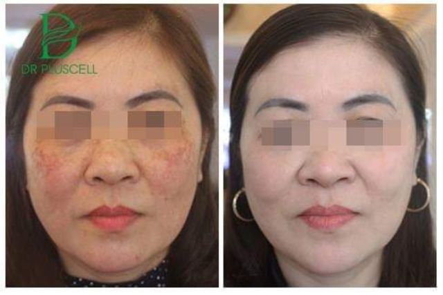 Tế bào gốc DR VITA C loại bỏ nám,tàn nhang Dr Pluscell_ CAM KẾT HÀNG CHÍNH HÃNG