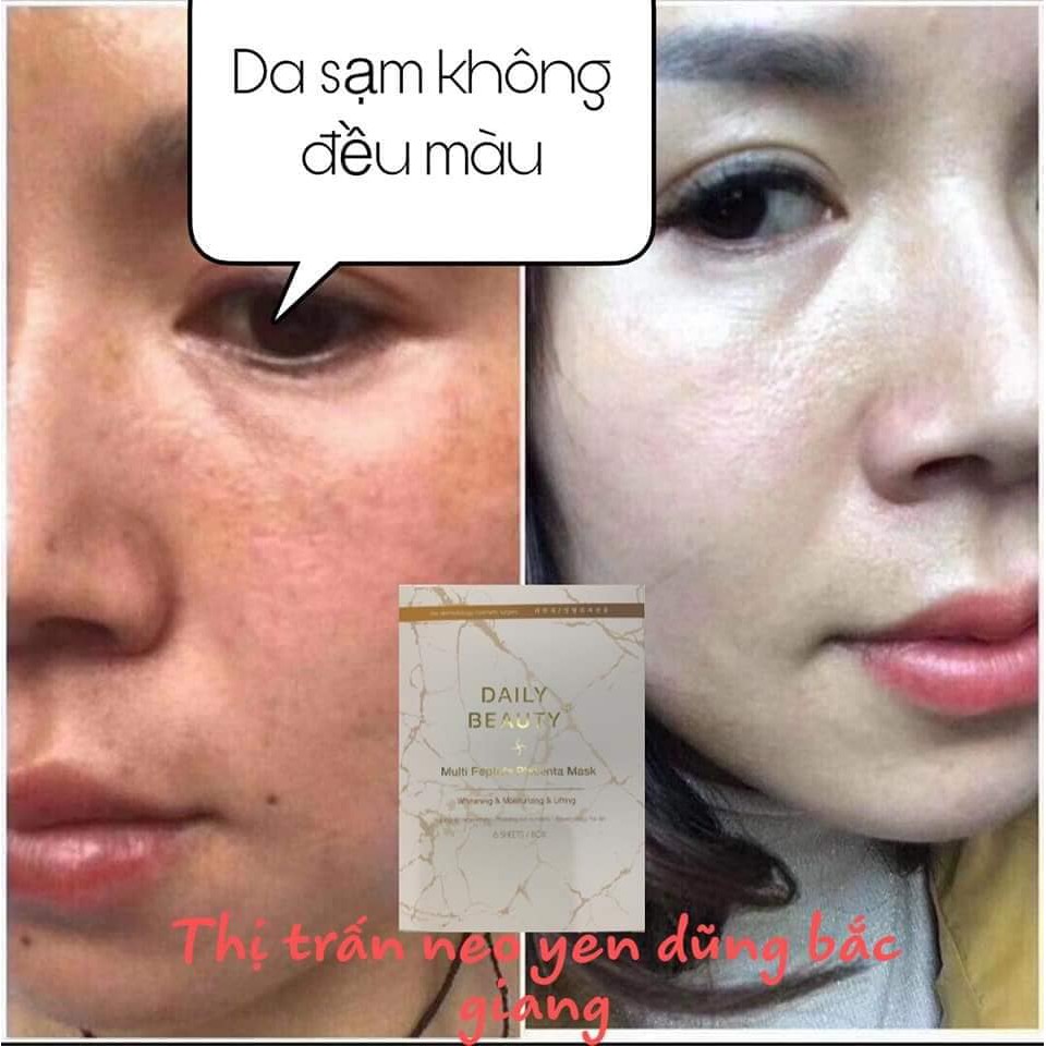 Mặt Nạ Làm Trắng, Hỗ Trợ Điều Trị Mụn, Làm Mờ Thâm Nám, Chống Nhăn Multi Peptide Placenta Mask Hàn Quốc