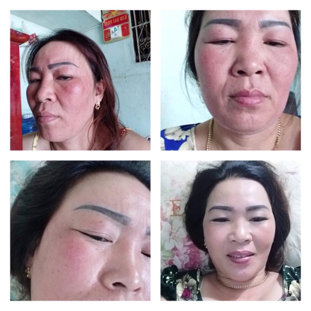 Serum TÁI TẠO THẢO DƯỢC NLS Loại bỏ Mụn - Nám - Tàn Nhang 100ml