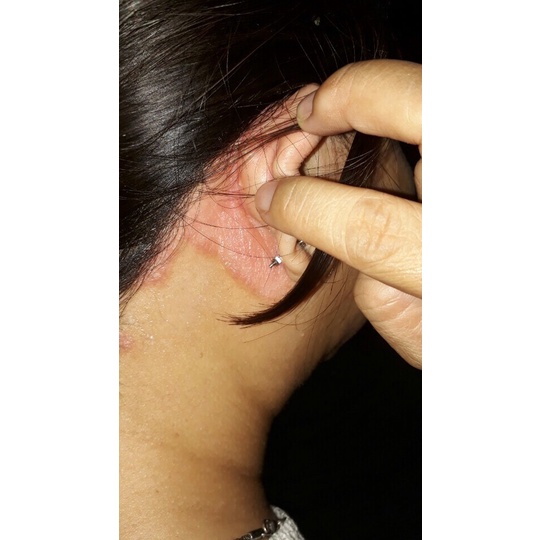 Thảo Dược Hết Sạch bong tróc, ngứa, lột vảy trắng từng mảng da đầu Vùng Tai (Đông Y Cổ Truyền)