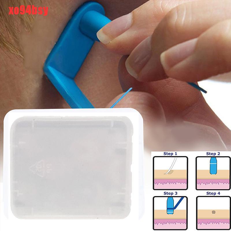 [xo94bsy]30Pc Skin Tag Removal Rubber Bands Micro Band Non Toxic Face Care Mole Wart