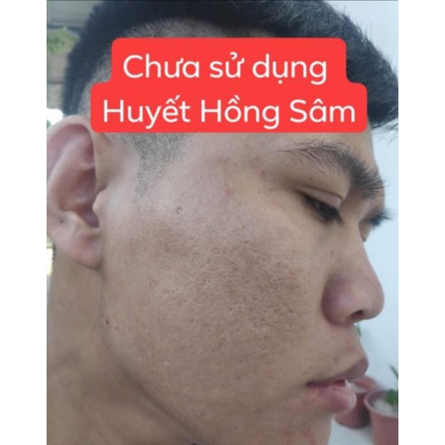 Huyết Hồng Sâm - Vua Diệt Mụn - Serum 10ml - Đông Y Vũ Đức | BigBuy360 - bigbuy360.vn