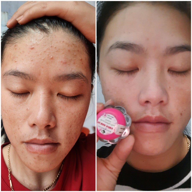 Kem Mụn Đông Y Hoa Đào Sạch Mụn, Trắng Da, Mờ Nám, Chấm Mụn Zini Store | BigBuy360 - bigbuy360.vn