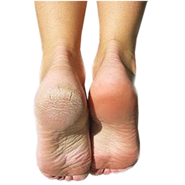 Kem chuối giảmnứt gót chân Thái lan