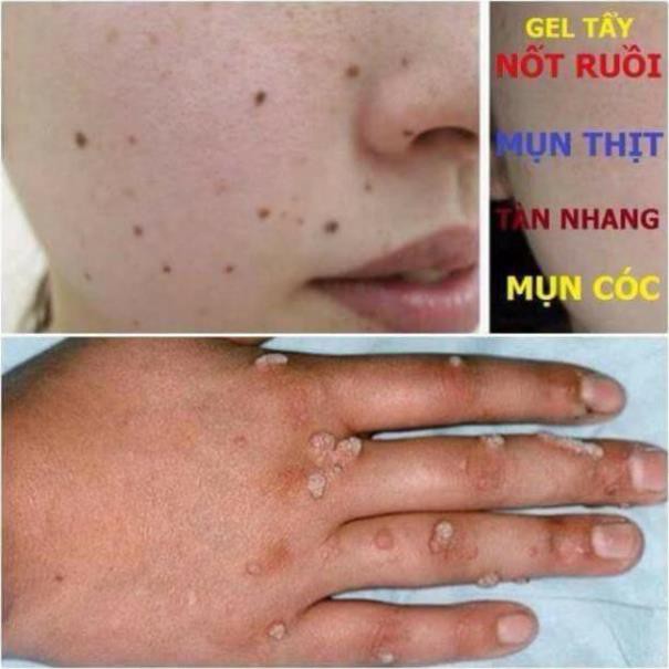 (Chuyên sỉ) Gel tẩy nốt ruồi, mụn thịt, mục cóc nga (hàng sịn) | BigBuy360 - bigbuy360.vn