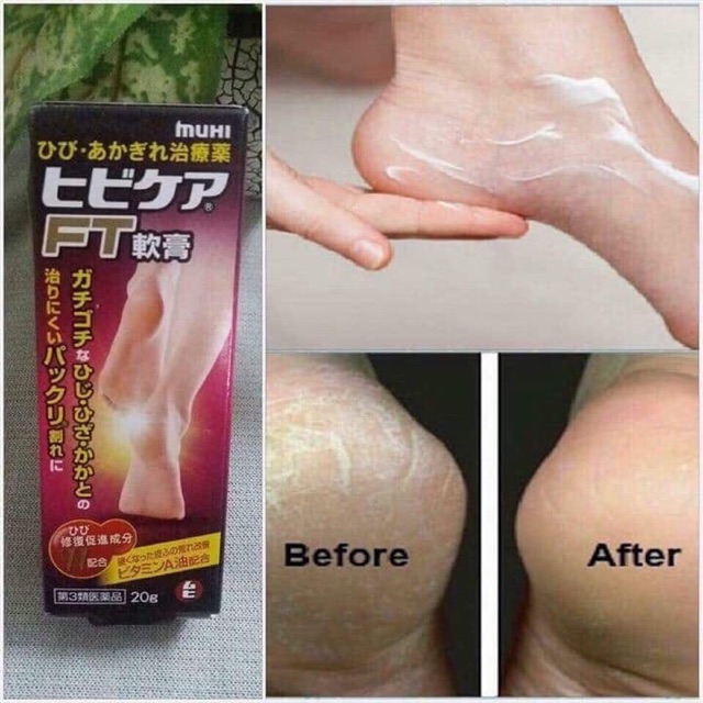 Kem trị nứt gót chân Muhi