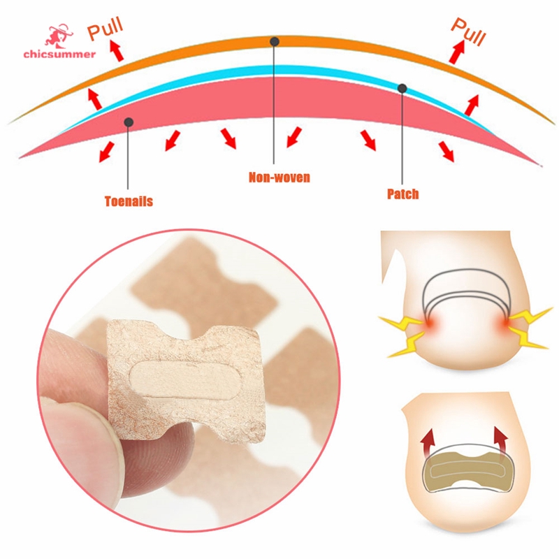 Miếng Dán Phục Hồi Móng Chân Mọc Ngược