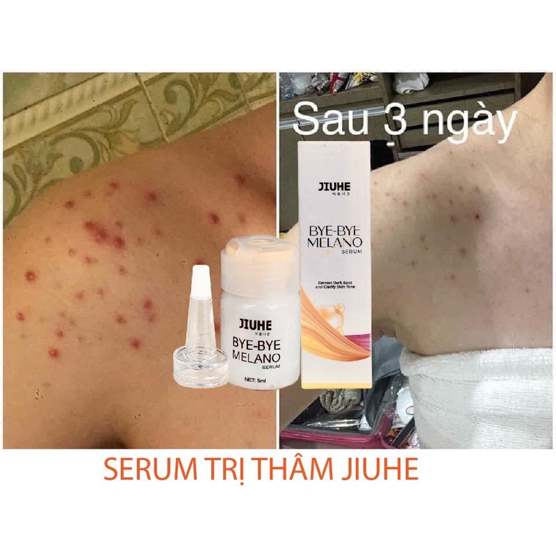 Serum tri thâm hàn quốc JIUHE Q-PEARL giảm thâm do mụn khửu tay chân, thâm sẹo, thâm nách hiệu quả