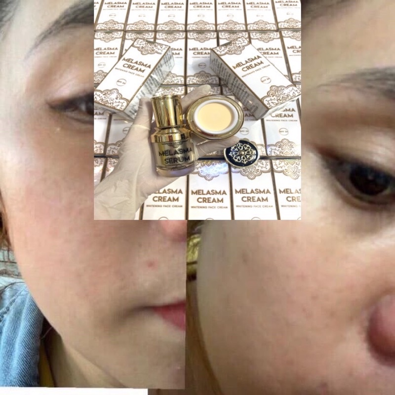 Bộ KEM NÁM CAO CẤP