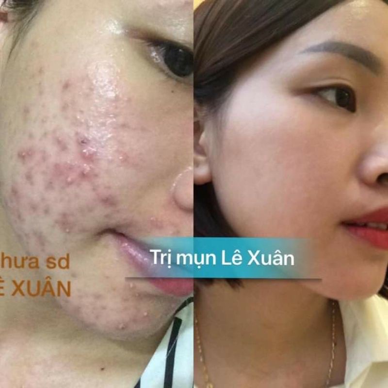 thảo dược đông y lê xuân💚 ngừa mụn lê xuân 💚 đánh bay mụn ẩn,mụn đầu đen,mụn bọc,mụn liti,mụn trứng cá... | BigBuy360 - bigbuy360.vn