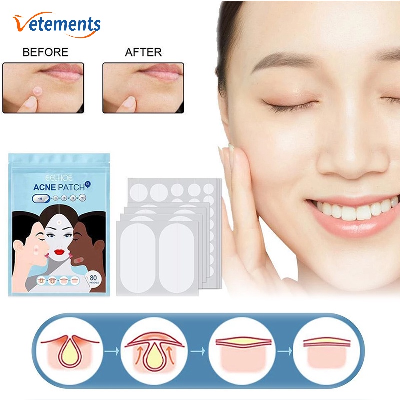 Set 80 Miếng Dán Hỗ trợ giảm mụn Vô Hình Chống Thấm Nước