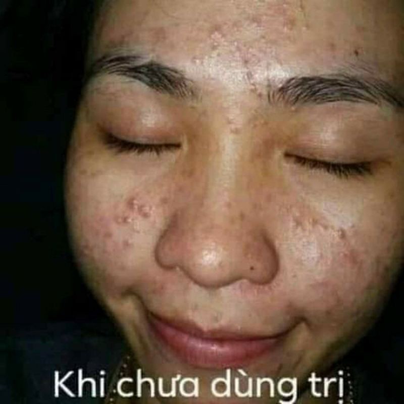 Kem mụn, chống nắng, dưỡng trắng, mờ thâm HUỲNH ĐỖ 50g | BigBuy360 - bigbuy360.vn