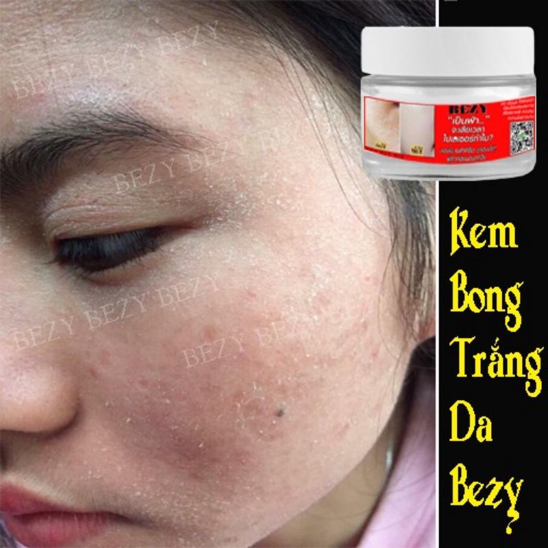 Kem Bong Da Mặt Trắng Da Mờ Thâm Nám