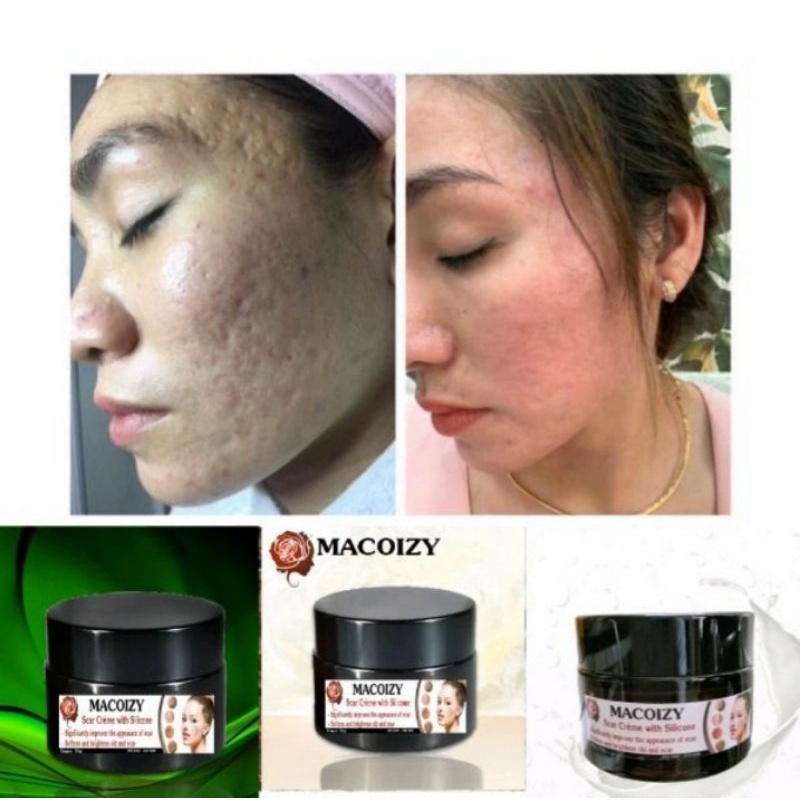 Combo serum Macoizy & Kem Xóa Sẹo rỗ