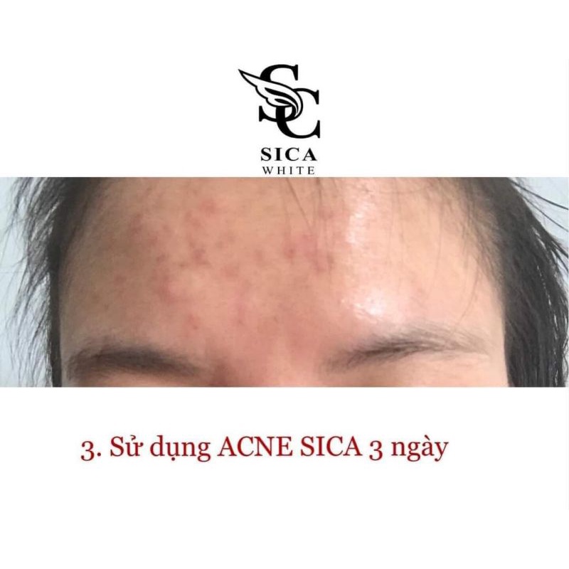 Face Mụn Sica | BigBuy360 - bigbuy360.vn