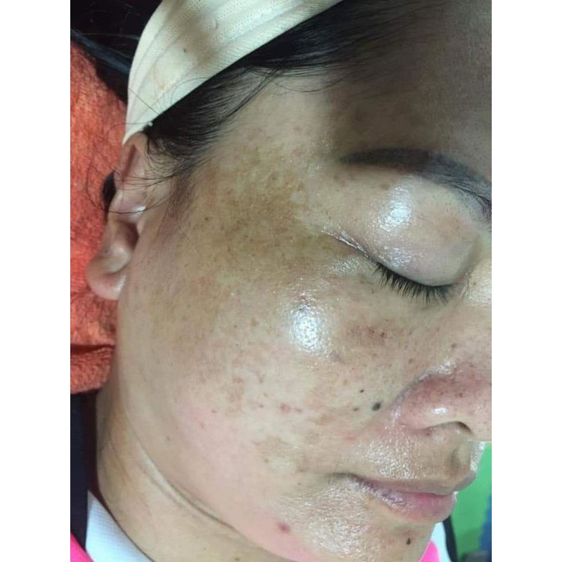 Bột Đánh Nám Tàn Nhang (gồm 2 bột và 1 lọ collagen đặc) | BigBuy360 - bigbuy360.vn