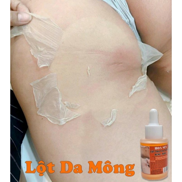 LỘT THAY DA MÔNG.HẾT THẰM MỜ RẠN.NỨT DA