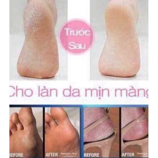 KEM CHUỐI TRỊ NỨT GÓT CHÂN THÁI LAN
