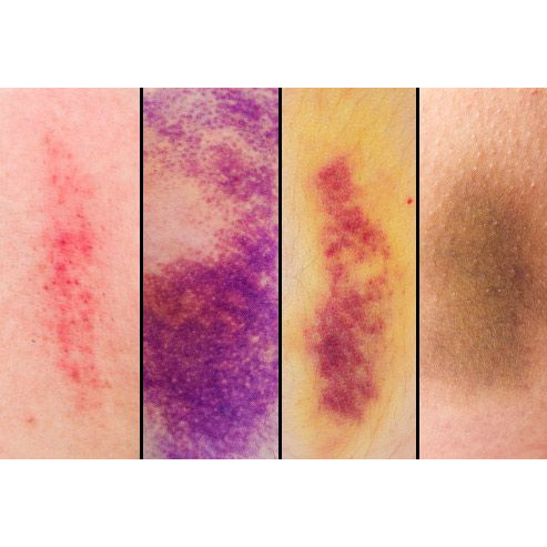 Kem Tan Máu Bầm Arnican Gel Nội Địa Pháp - 50g
